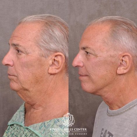 Beverly Hills Center Male Patient Before and After Weekend Necklift