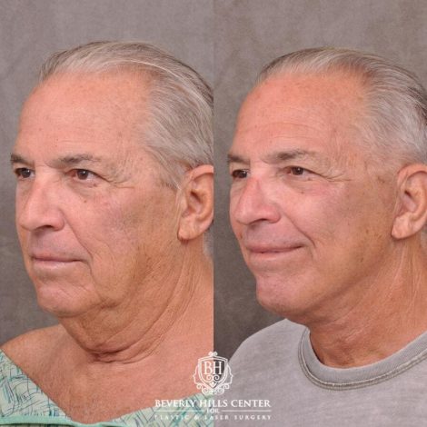 Beverly Hills Center Male Patient Before and After Weekend Necklift