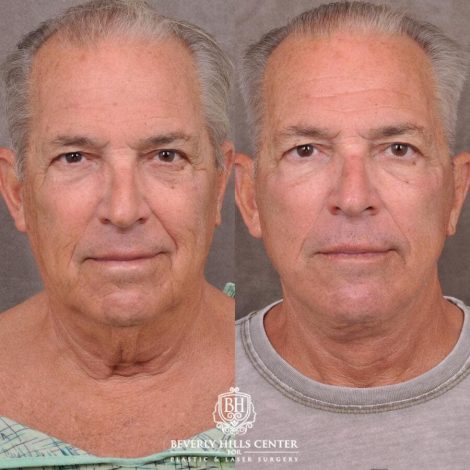 Beverly Hills Center Male Patient Before and After Weekend Necklift