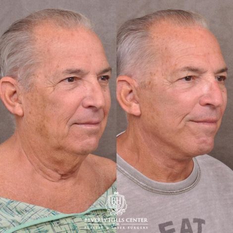 Beverly Hills Center Male Patient Before and After Weekend Necklift