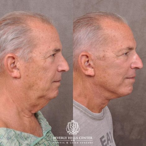 Beverly Hills Center Male Patient Before and After Weekend Necklift