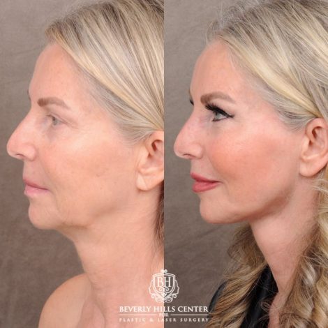 Beverly Hills Center Female Patient Before and After AuraLyft, CUPID LIFT® Corner Lift, Temporal Brow Reset, Upper Blepharoplasty with Ptosis Repair