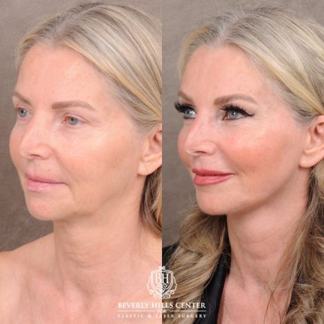 Beverly Hills Center Female Patient Before and After AuraLyft, CUPID LIFT® Corner Lift, Temporal Brow Reset, Upper Blepharoplasty with Ptosis Repair