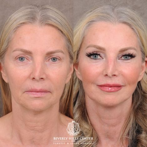 Beverly Hills Center Female Patient Before and After AuraLyft, CUPID LIFT® Corner Lift, Temporal Brow Reset, Upper Blepharoplasty with Ptosis Repair