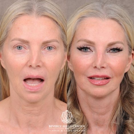 Beverly Hills Center Female Patient Before and After AuraLyft, CUPID LIFT® Corner Lift, Temporal Brow Reset, Upper Blepharoplasty with Ptosis Repair