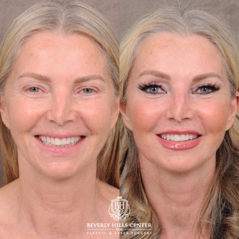 Beverly Hills Center Female Patient Before and After AuraLyft, CUPID LIFT® Corner Lift, Temporal Brow Reset, Upper Blepharoplasty with Ptosis Repair