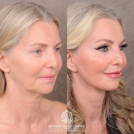 Beverly Hills Center Female Patient Before and After AuraLyft, CUPID LIFT® Corner Lift, Temporal Brow Reset, Upper Blepharoplasty with Ptosis Repair