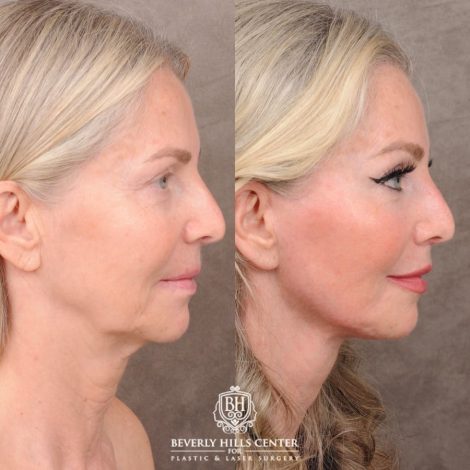 Beverly Hills Center Female Patient Before and After AuraLyft, CUPID LIFT® Corner Lift, Temporal Brow Reset, Upper Blepharoplasty with Ptosis Repair