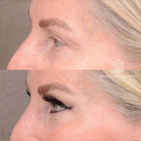 Beverly Hills Center Female Patient Before and After AuraLyft, CUPID LIFT® Corner Lift, Temporal Brow Reset, Upper Blepharoplasty with Ptosis Repair