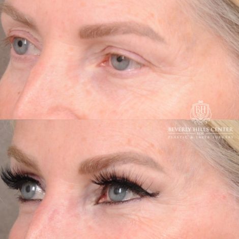 Beverly Hills Center Female Patient Before and After AuraLyft, CUPID LIFT® Corner Lift, Temporal Brow Reset, Upper Blepharoplasty with Ptosis Repair
