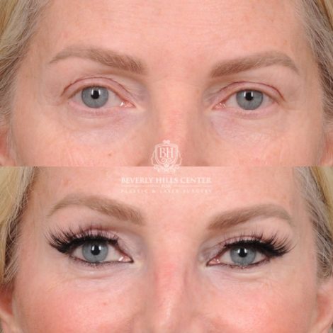 Beverly Hills Center Female Patient Before and After AuraLyft, CUPID LIFT® Corner Lift, Temporal Brow Reset, Upper Blepharoplasty with Ptosis Repair
