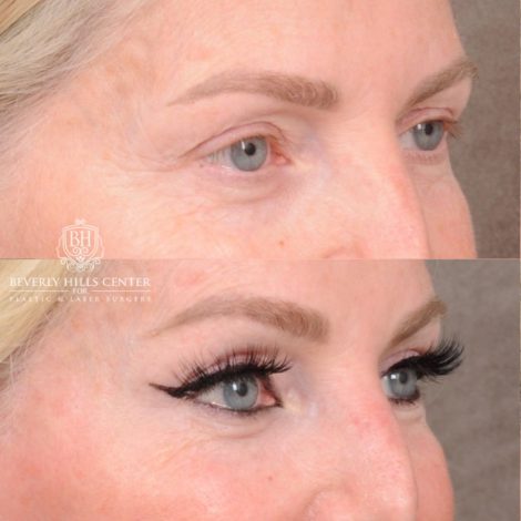 Beverly Hills Center Female Patient Before and After AuraLyft, CUPID LIFT® Corner Lift, Temporal Brow Reset, Upper Blepharoplasty with Ptosis Repair