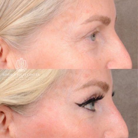 Beverly Hills Center Female Patient Before and After AuraLyft, CUPID LIFT® Corner Lift, Temporal Brow Reset, Upper Blepharoplasty with Ptosis Repair