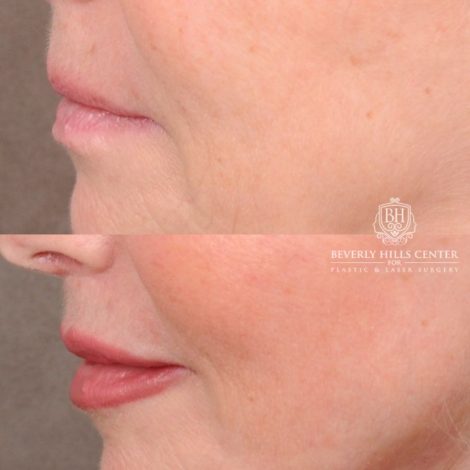 Beverly Hills Center Female Patient Before and After AuraLyft, CUPID LIFT® Corner Lift, Temporal Brow Reset, Upper Blepharoplasty with Ptosis Repair