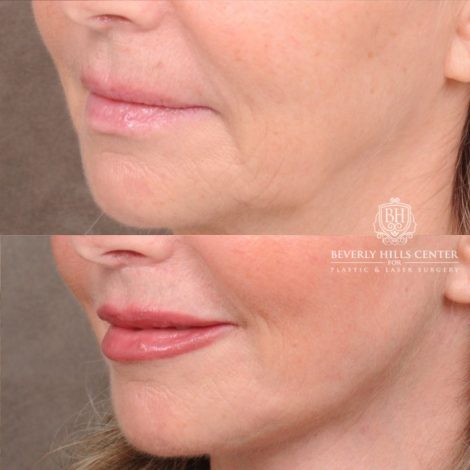 Beverly Hills Center Female Patient Before and After AuraLyft, CUPID LIFT® Corner Lift, Temporal Brow Reset, Upper Blepharoplasty with Ptosis Repair
