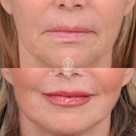 Beverly Hills Center Female Patient Before and After AuraLyft, CUPID LIFT® Corner Lift, Temporal Brow Reset, Upper Blepharoplasty with Ptosis Repair
