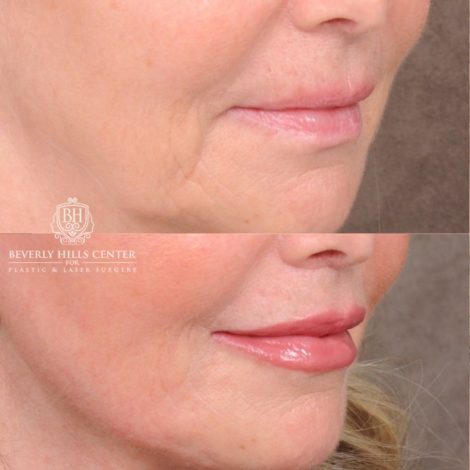 Beverly Hills Center Female Patient Before and After AuraLyft, CUPID LIFT® Corner Lift, Temporal Brow Reset, Upper Blepharoplasty with Ptosis Repair