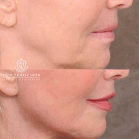 Beverly Hills Center Female Patient Before and After AuraLyft, CUPID LIFT® Corner Lift, Temporal Brow Reset, Upper Blepharoplasty with Ptosis Repair