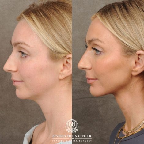 Beverly Hills Center Female Patient Before and After Weekend Necklift