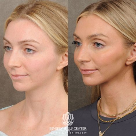 Beverly Hills Center Female Patient Before and After Weekend Necklift