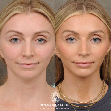Beverly Hills Center Female Patient Before and After Weekend Necklift