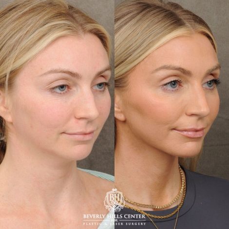 Beverly Hills Center Female Patient Before and After Weekend Necklift