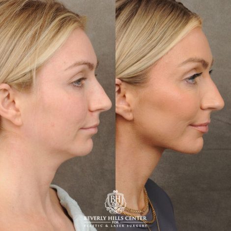 Beverly Hills Center Female Patient Before and After Weekend Necklift