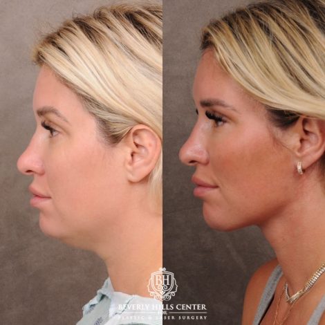 Beverly Hills Center Female Patient Before and After Weekend Necklift