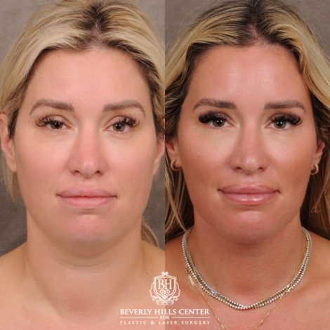 Beverly Hills Center Female Patient Before and After Weekend Necklift