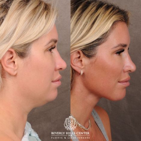 Beverly Hills Center Female Patient Before and After Weekend Necklift