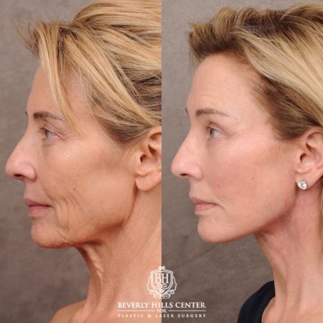 Beverly Hills Center Female Patient Before and After AuraLyft, Temporal Brow Reset, Upper Blepharoplasty with Ptosis Repair