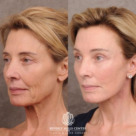 Beverly Hills Center Female Patient Before and After AuraLyft, Temporal Brow Reset, Upper Blepharoplasty with Ptosis Repair