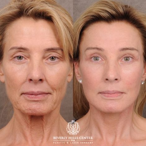 Beverly Hills Center Female Patient Before and After AuraLyft, Temporal Brow Reset, Upper Blepharoplasty with Ptosis Repair