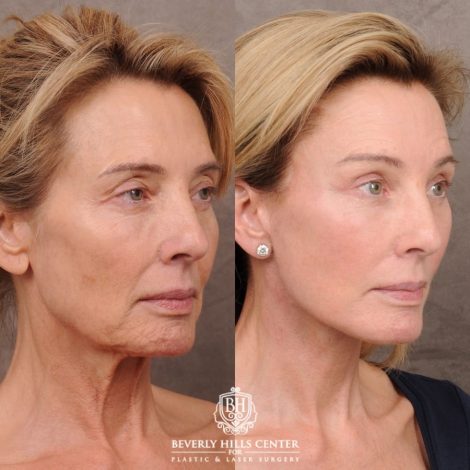 Beverly Hills Center Female Patient Before and After AuraLyft, Temporal Brow Reset, Upper Blepharoplasty with Ptosis Repair