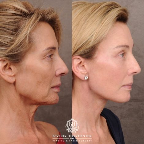 Beverly Hills Center Female Patient Before and After AuraLyft, Temporal Brow Reset, Upper Blepharoplasty with Ptosis Repair