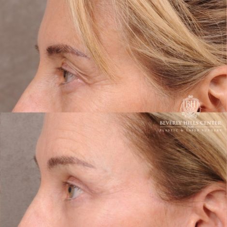 Beverly Hills Center Female Patient Before and After AuraLyft, Temporal Brow Reset, Upper Blepharoplasty with Ptosis Repair