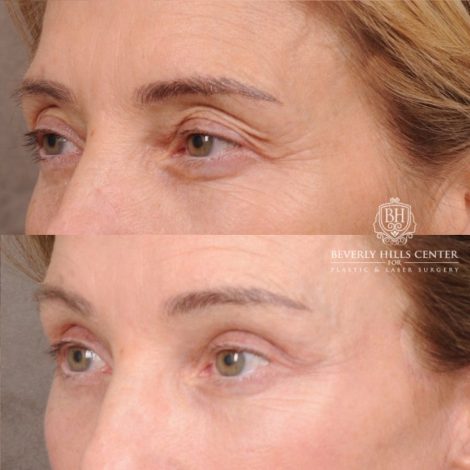Beverly Hills Center Female Patient Before and After AuraLyft, Temporal Brow Reset, Upper Blepharoplasty with Ptosis Repair