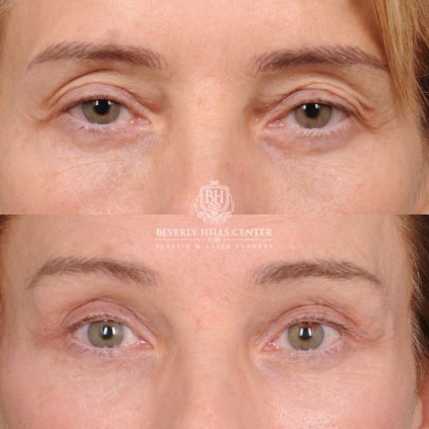 Beverly Hills Center Female Patient Before and After AuraLyft, Temporal Brow Reset, Upper Blepharoplasty with Ptosis Repair