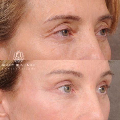 Beverly Hills Center Female Patient Before and After AuraLyft, Temporal Brow Reset, Upper Blepharoplasty with Ptosis Repair