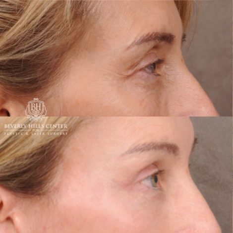 Beverly Hills Center Female Patient Before and After AuraLyft, Temporal Brow Reset, Upper Blepharoplasty with Ptosis Repair