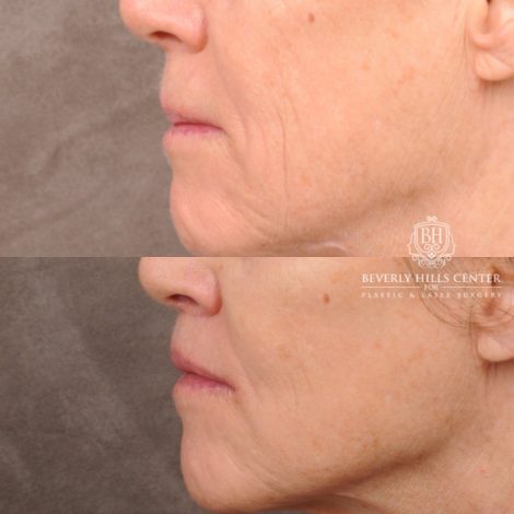 Beverly Hills Center Female Patient Before and After CUPID LIFT® Lip Lift, PHAT Lips