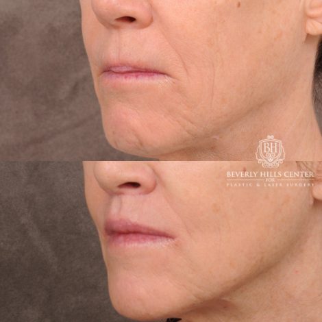 Beverly Hills Center Female Patient Before and After CUPID LIFT® Lip Lift, PHAT Lips