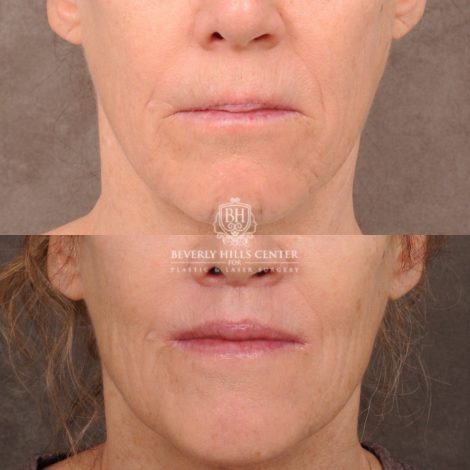Beverly Hills Center Female Patient Before and After CUPID LIFT® Lip Lift, PHAT Lips