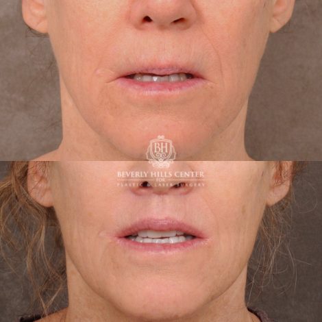 Beverly Hills Center Female Patient Before and After CUPID LIFT® Lip Lift, PHAT Lips