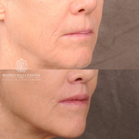 Beverly Hills Center Female Patient Before and After CUPID LIFT® Lip Lift, PHAT Lips