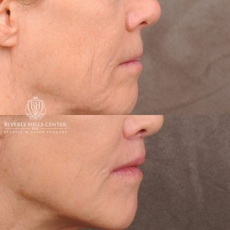 Beverly Hills Center Female Patient Before and After CUPID LIFT® Lip Lift, PHAT Lips