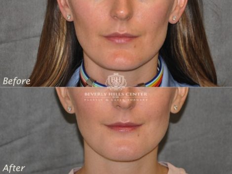 Beverly Hills Center Female Patient Before and After Weekend Necklift