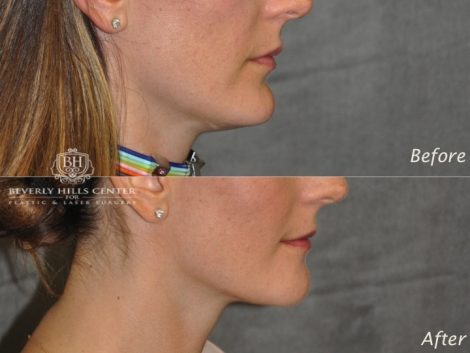 Beverly Hills Center Female Patient Before and After Weekend Necklift