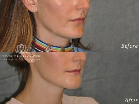 Beverly Hills Center Female Patient Before and After Weekend Necklift