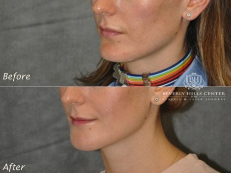 Beverly Hills Center Female Patient Before and After Weekend Necklift